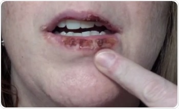 Actinic Cheilitis